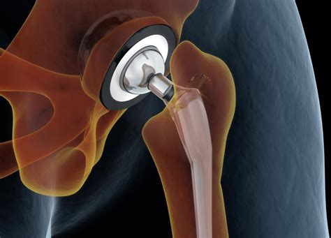 Identifying Hip Pathology with Surgical Repairs and Replacement of the Hip - Allied Health Education