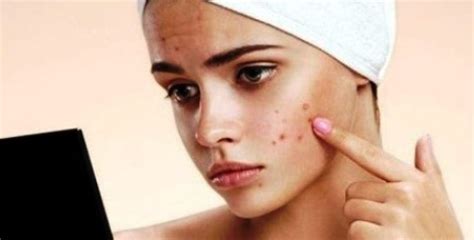 How To Treat Deep, Painful Pimples By Viksha Skin Clinic