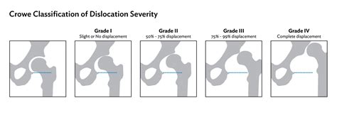 Diagnosis - International Hip Dysplasia Institute