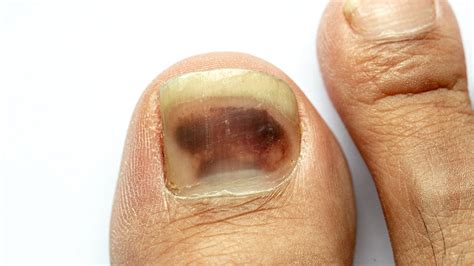 fingernail melanoma images | Symptoms and pictures