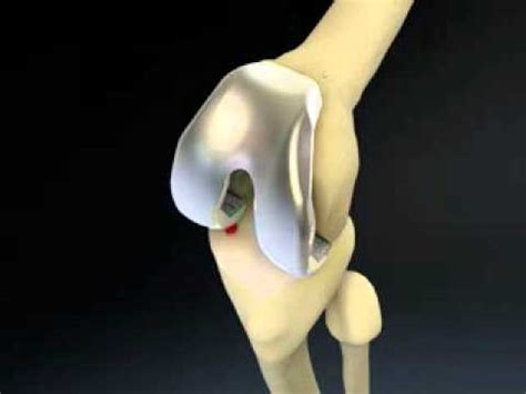 Biomet Vanguard Total Knee Replacement Animation - YouTube