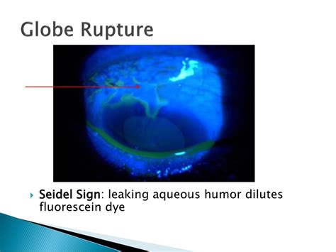 Ocular Trauma Dr.saif alshamarti. - ppt download