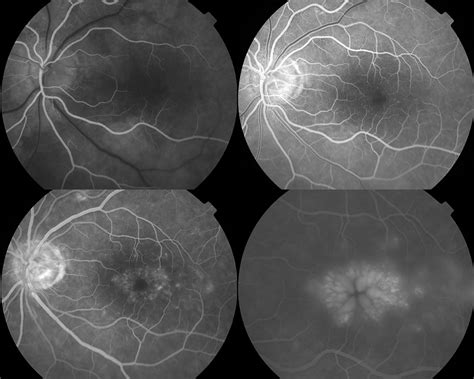 Clinically Significant Macular Edema