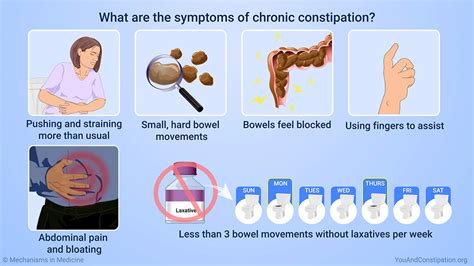 Slide Show - Understanding Chronic Constipation