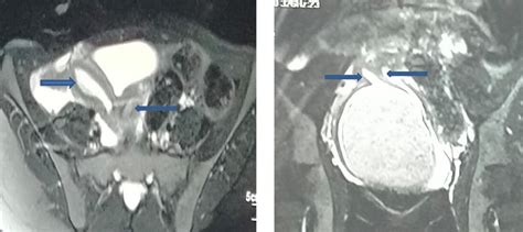 -MRI Pelvis demonstrates, (A) uterus didelphys, (B) hematometrocolpos... | Download Scientific ...