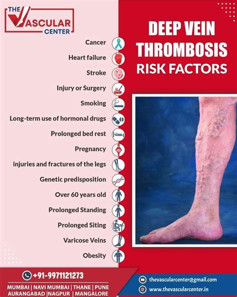 Deep Vein Thrombosis, DVT Symptoms, Causes And, 56% OFF