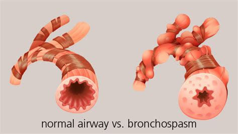 What is Asthma? | Allergy & Asthma Network