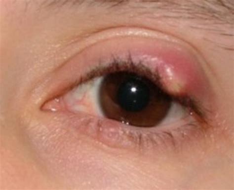 Stye Eye - Causes, Symptoms, Pictures, Treatment, Prevention | Diseases Pictures