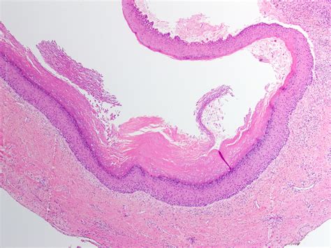 Odontogenic Keratocyst Histology