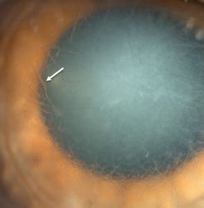 Epithelial-stromal TGFBI-associated corneal dystrophies: for professionals - Gene Vision