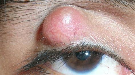 Meibomian Cyst Vs Chalazion