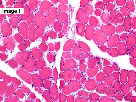 Myotonic Dystrophy Type 2 | Neuro Notes | Arkana Laboratories