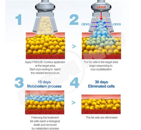 Cryolipolysis-Info - HydraFacial MD