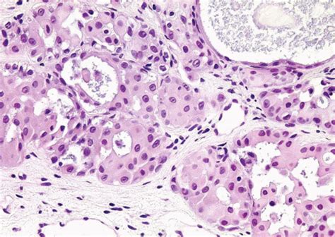 Histologic Variants of Urothelial Carcinoma | Abdominal Key