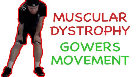 Muscular Dystrophy Gowers Maneuver - YouTube