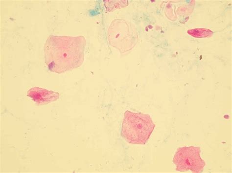 Epithelial cells in urine - what does it mean if you have epithelial cells in urine