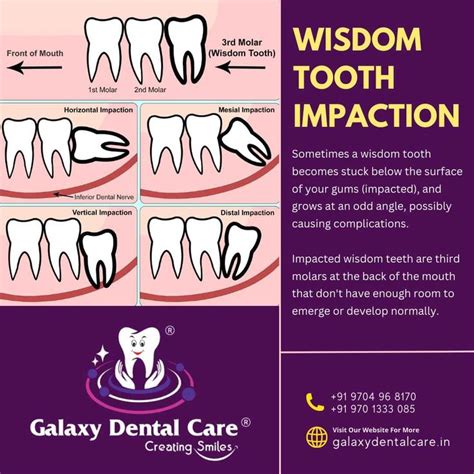 Wisdom tooth impaction | Impacted wisdom teeth, Wisdom teeth, Impaction