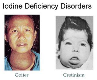 Iodine Deficiency - Causes, Symptoms, Diagnosis, Treatment and Prognosis