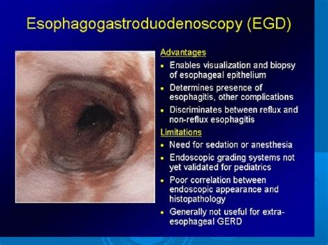 acid peptic disease