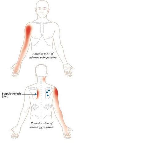 The Iliopsoas Muscle: Pain & Trigger Points | Pso-Rite™