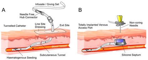 Non Tunneled Central Venous Catheter