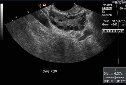 Polycystic ovaries | Radiology Reference Article | Radiopaedia.org