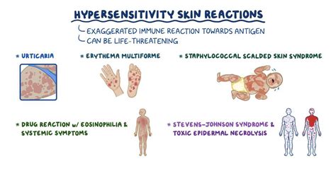 Arthus Reaction: What Is It, Causes and More | Osmosis