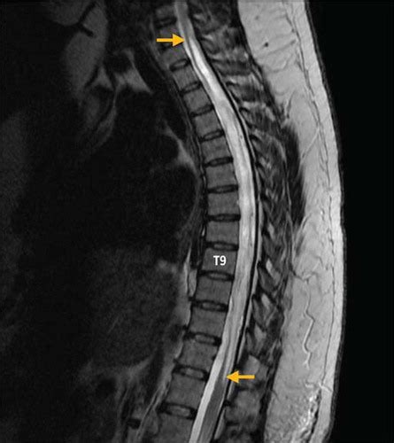 Thoracic Syrinx in a Patient With Balance Difficulties | Journal of Orthopaedic & Sports ...