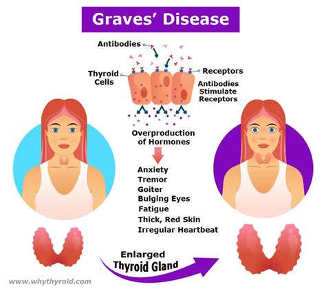 Graves' Disease - Causes, Symptoms, Diagnosis, Treatment- Why Thyroid