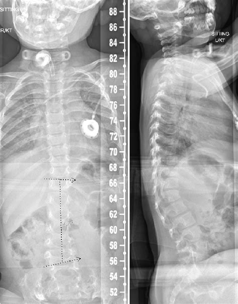 2 view Spine films demonstrating a dextroconvex curvature of the... | Download Scientific Diagram