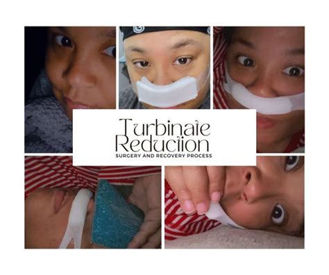 Turbinate Reduction: Surgery and the Recovery Process – Simply mlatrece