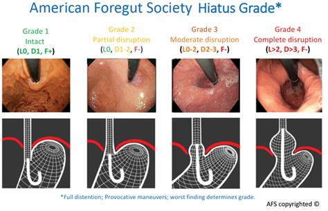 AFS Classification Characterizes EGJ Integrity in GERD