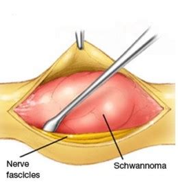 Schwannomas (Nerve Sheath Tumor) Symptoms, Treatment « CancerWORLD