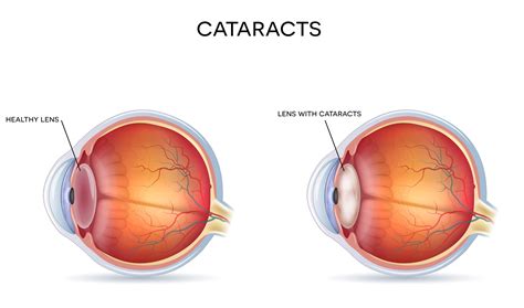 Are Cataracts Always Visible? Early Signs of Cataracts to Look For