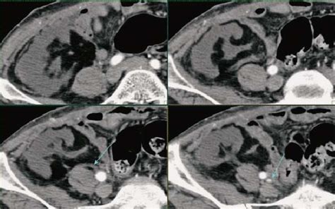 Contrast enhanced CT, arterial phase. Kidney transplant without signs ...