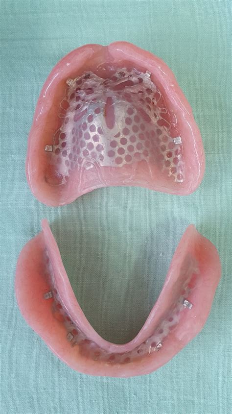 Complete Dentures - Northland Prosthodontics - Northland Denture ...