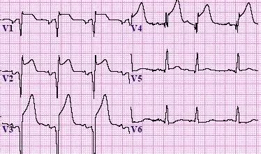 Mi Ekg