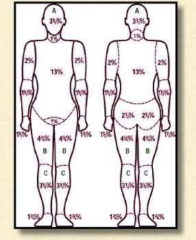 Severity of Burns - The Burn Experts