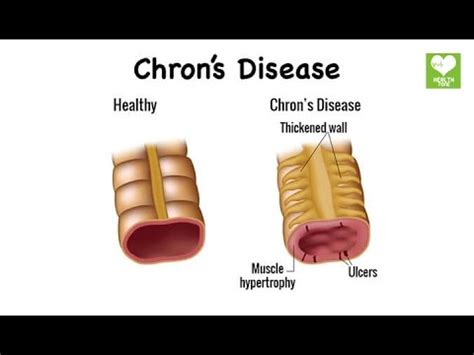 Crohn's Disease - Natural Home Remedies - YouTube