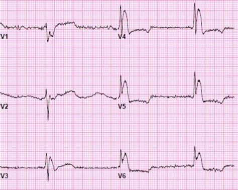 55 year old male with altered mental status, hypothermia, and Osborn waves - ACLS Medical Training