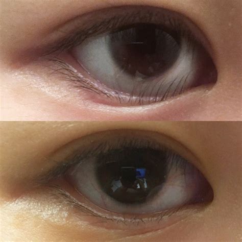 This Woman Had Lower Eyelid Surgery, and It Completely Changed Her Life ...