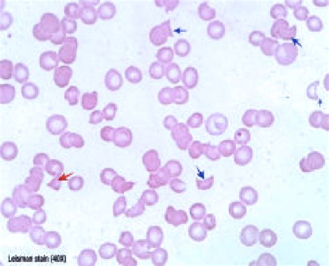 ; Peripheral blood smear (leishman stain 40X) show fragmented ...