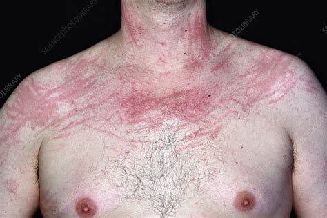 Dermatographic urticaria - Stock Image - C028/4400 - Science Photo Library