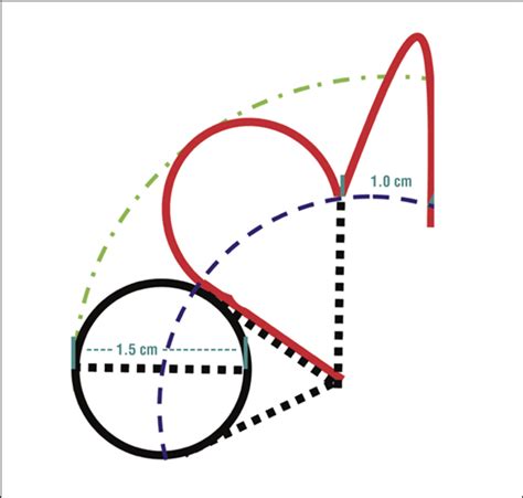 Modification of the Zitelli Bilobed Flap: A Comparison of Flap Dynamics in Human Cadavers | JAMA ...