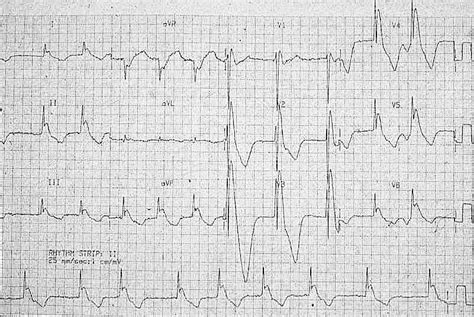 Osborn Wave (J Wave) • LITFL • ECG Library Basics