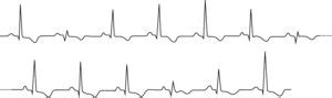 Eletrical alternans: the ECG in pericardial effusion & cardiac tamponade – EKG & ECHO