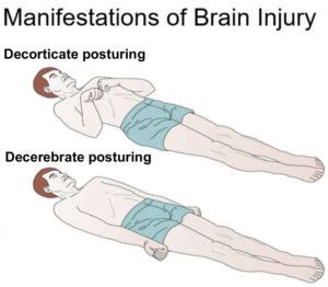 Decorticate and decerebrate posturing causes & treatment