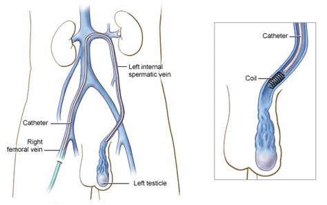 Variocele surgery| Laparoscopic Varicocelectomy| Mumbai| India