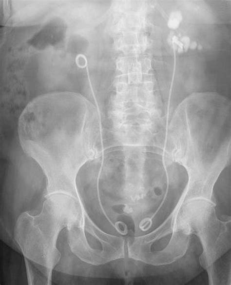 Indications and Complications of Ureteric Stent - MEDizzy