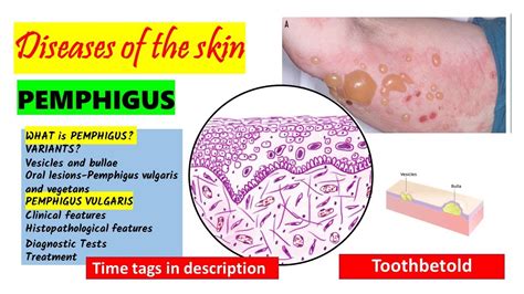 Pemphigus Vulgaris | HISTOPATHOLOGY | Immunofluorescence | Treatment ...